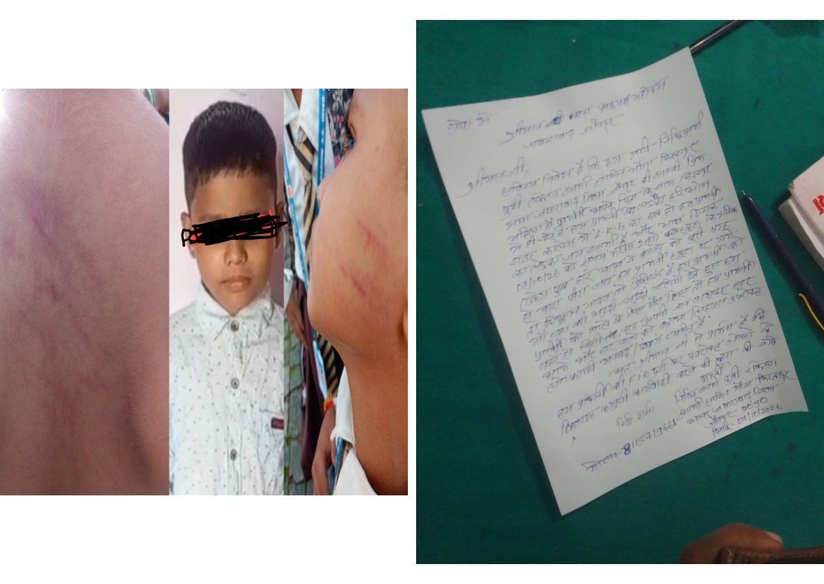 जौनपुर स्कूल में कथित मारपीट के बाद बच्चे के चेहरे और पीठ पर चोट के निशान